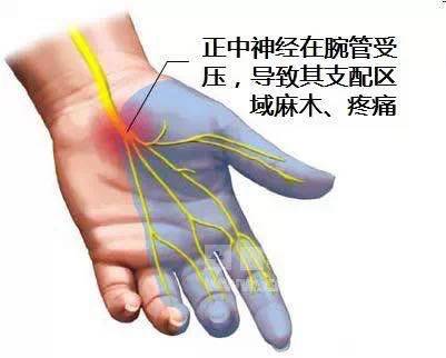 如何科学防治腕管综合征